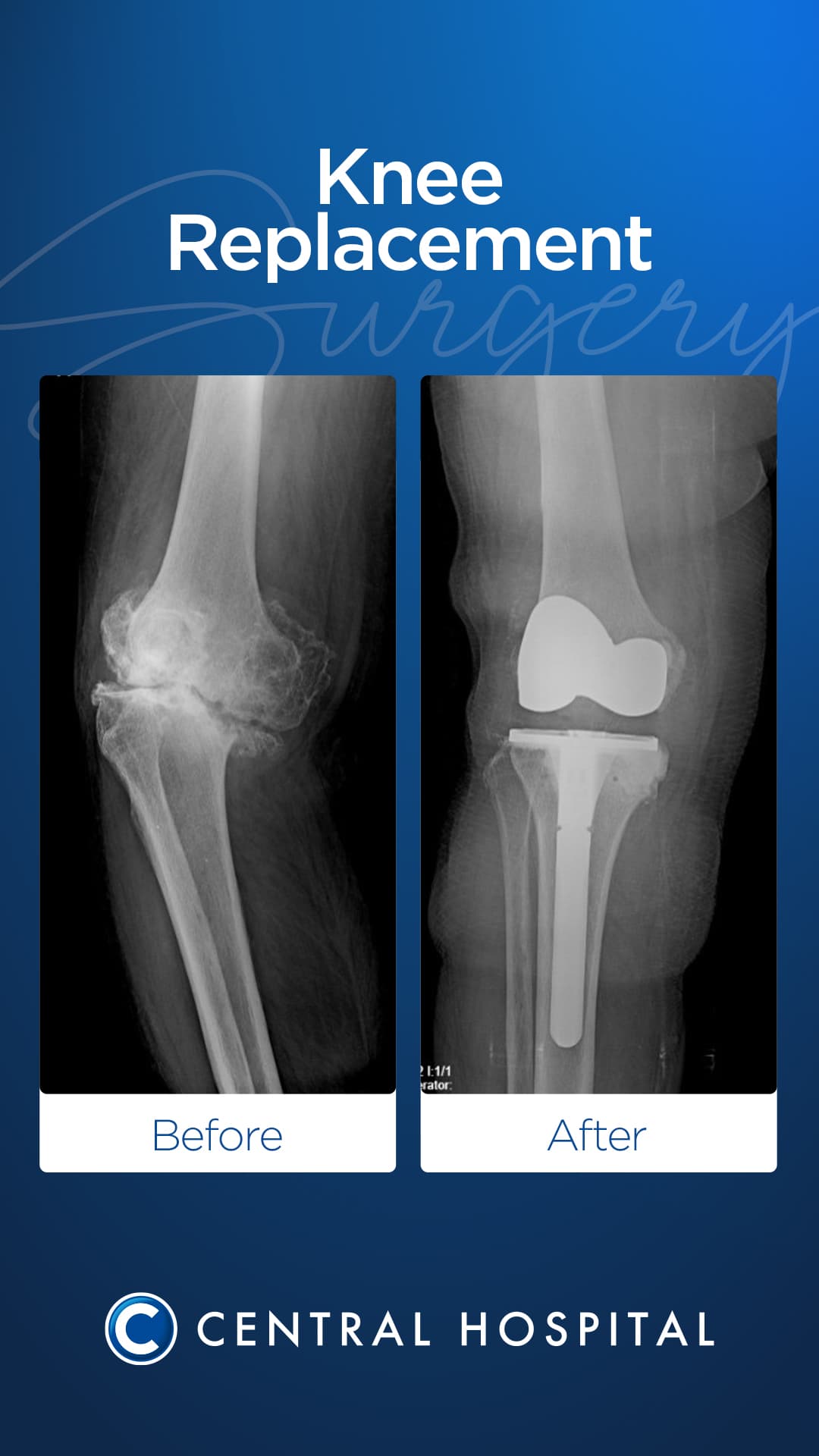 Total Knee Replacement — before and after — Central Hospital Istanbul