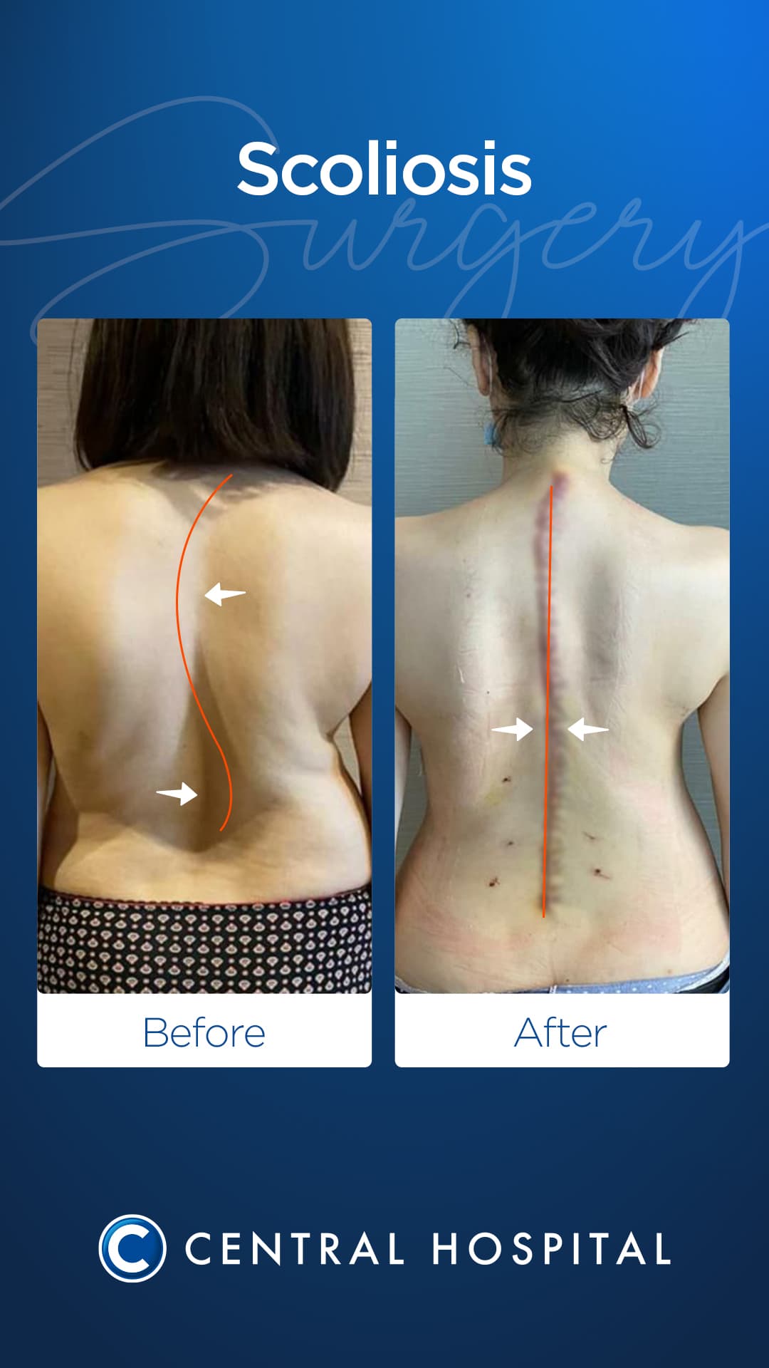 Scoliosis Surgery — before and after — Central Hospital Istanbul