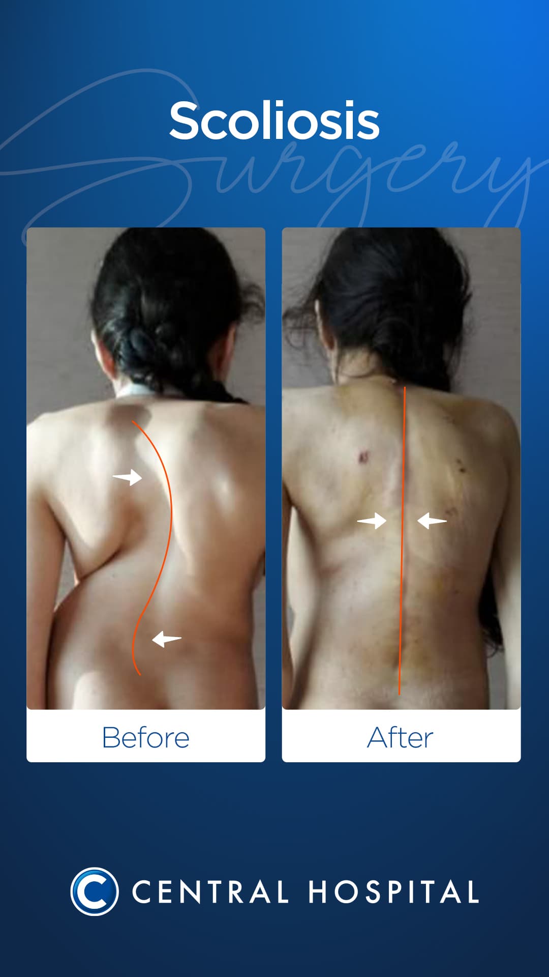Scoliosis Surgery — before and after — Central Hospital Istanbul